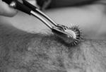 Image of pinwheel being used on nipple